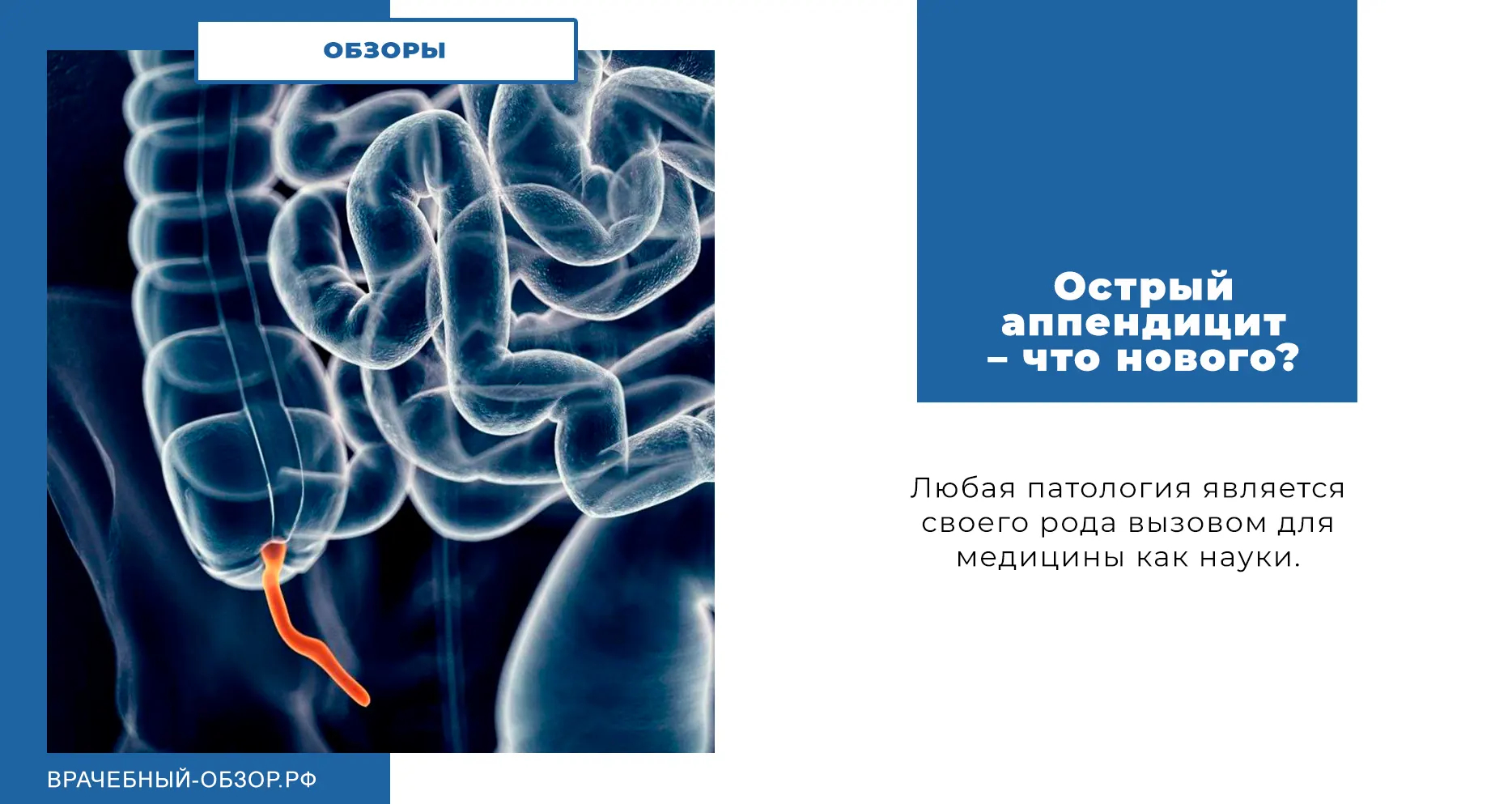Острый аппендицит – что нового?