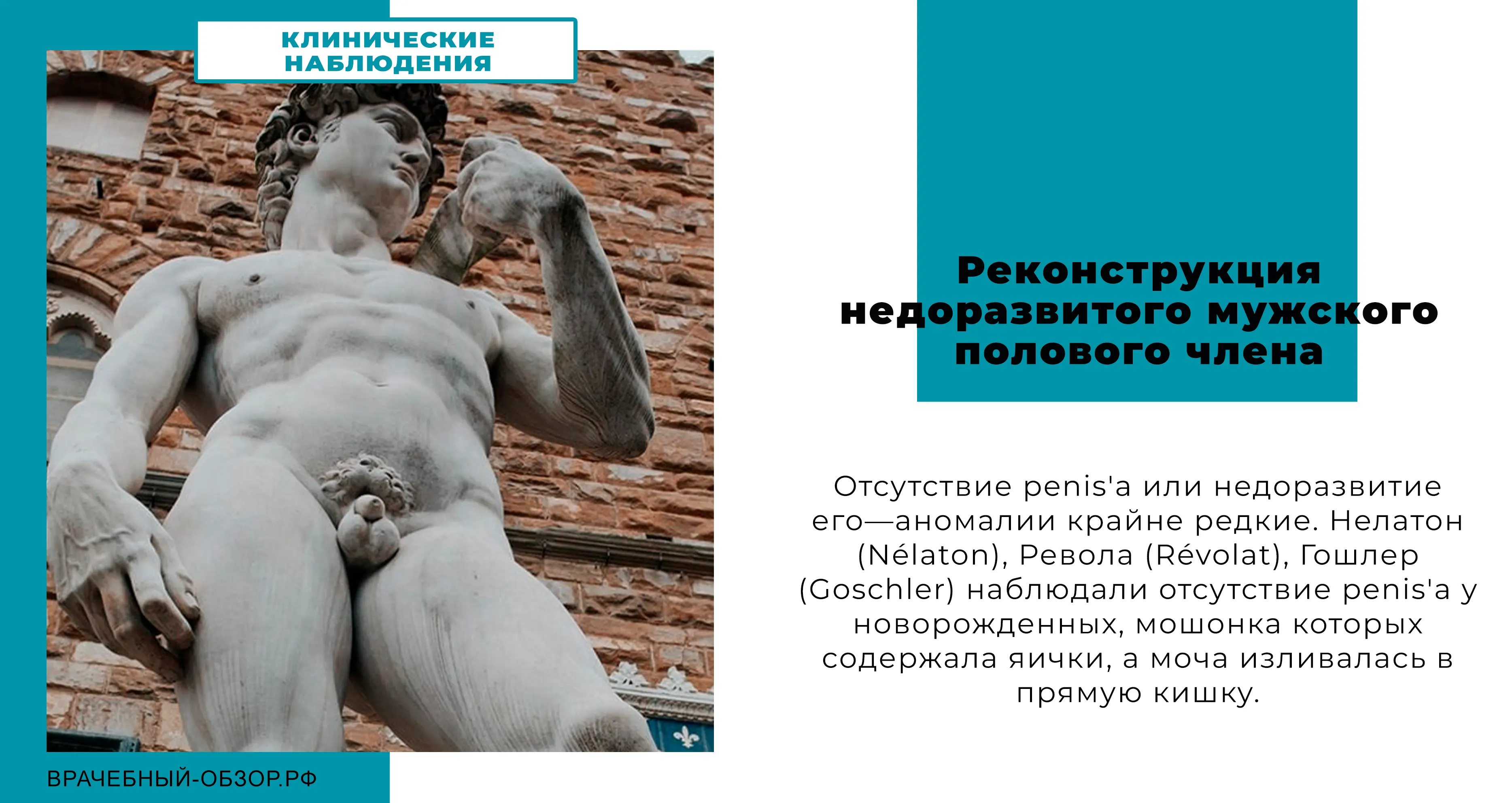 Реконструкция недоразвитого мужского полового члена