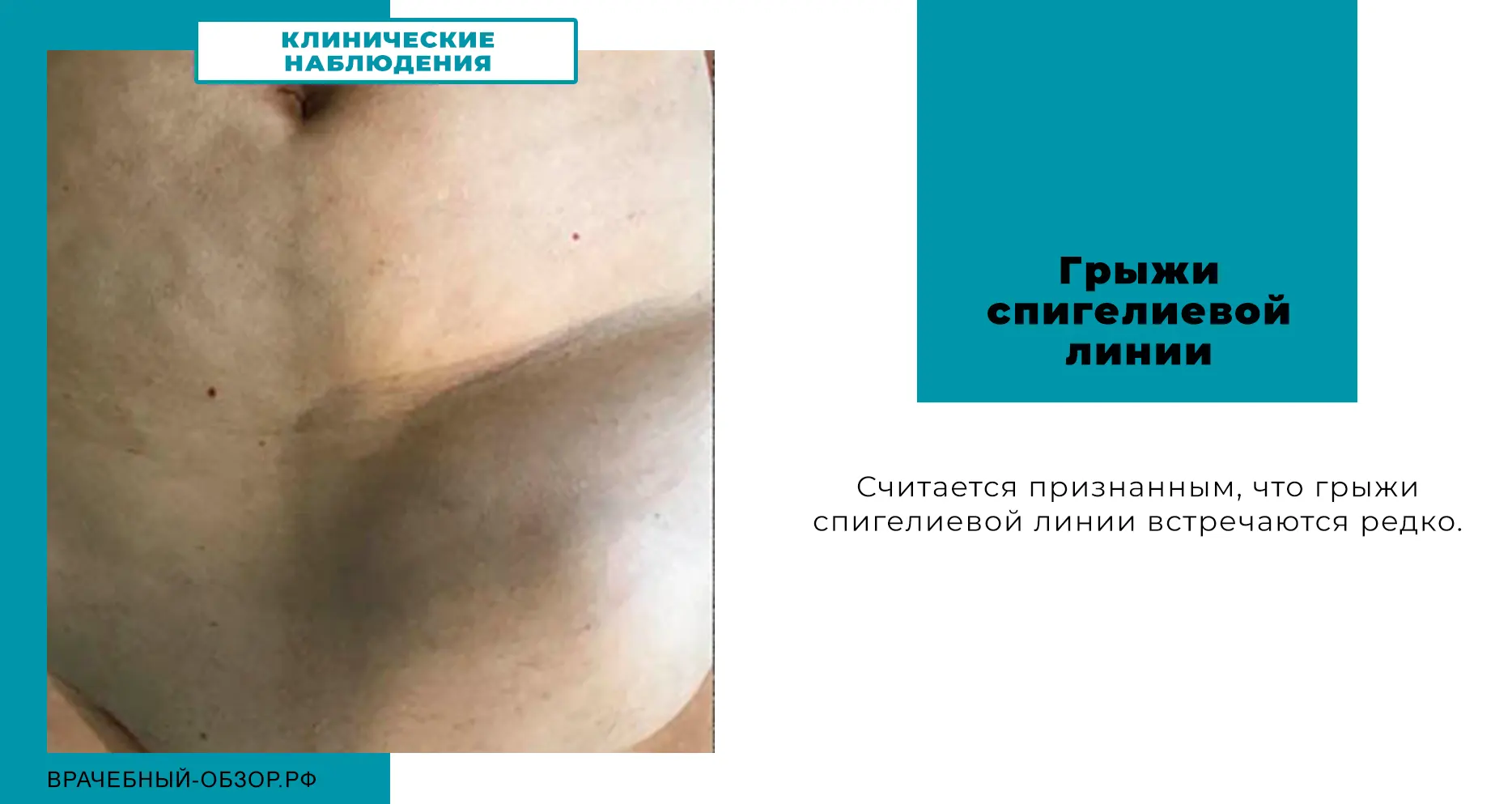 Грыжи спигелиевой линии