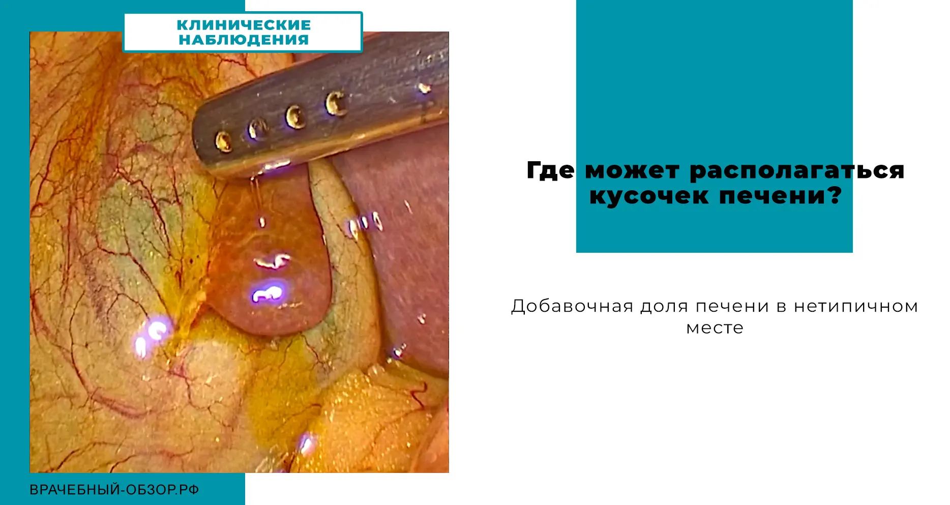Где может располагаться кусочек печени?